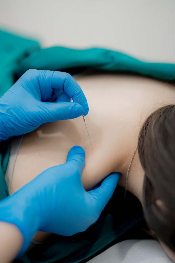 The Needle’s Edge: Transforming Pain Management with Dry Needling 1 Dry Needling