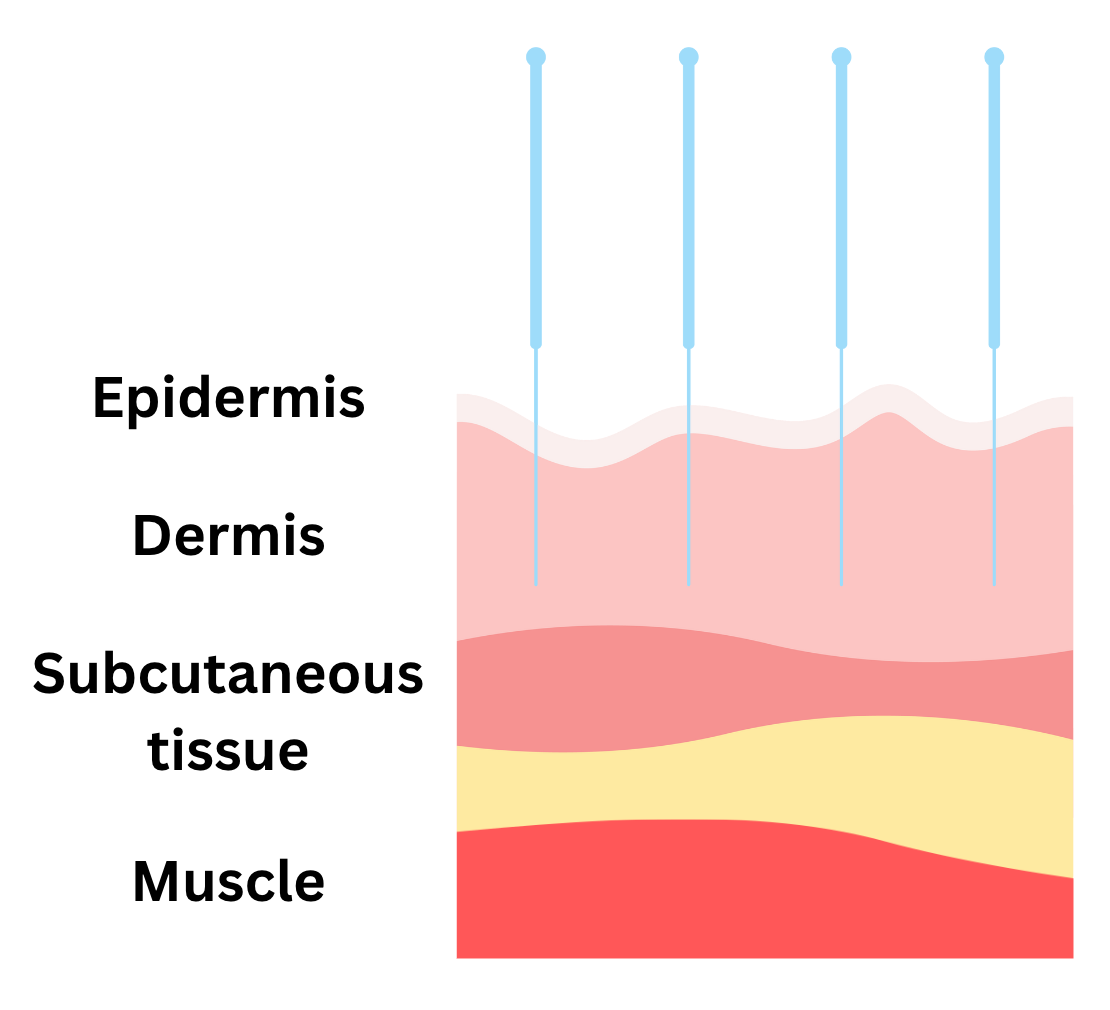 Dry needling layer