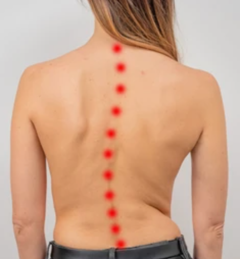 Scoliosis 0 1