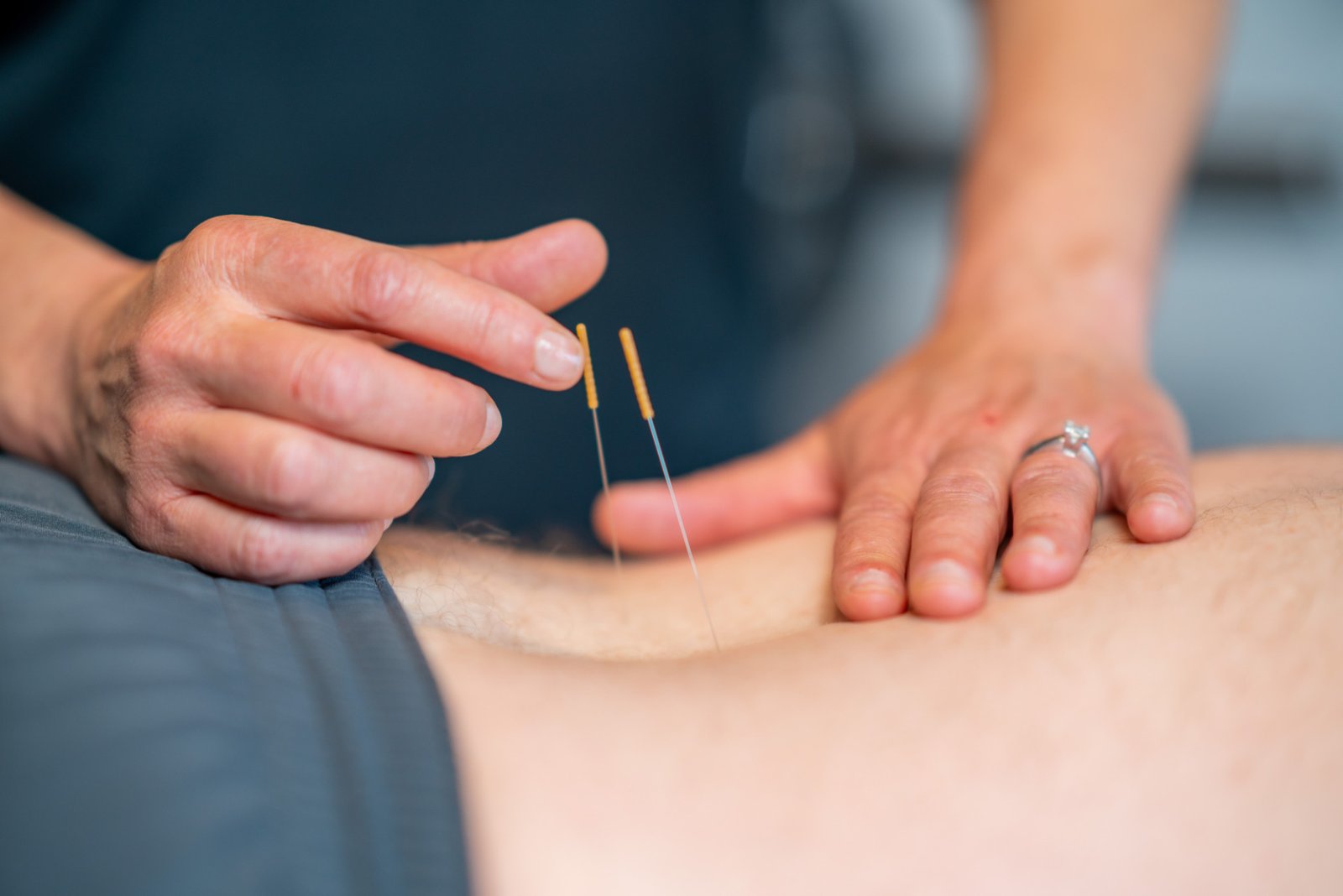 dry-needling-2 dry-needling-2
